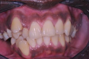 composiet veneers