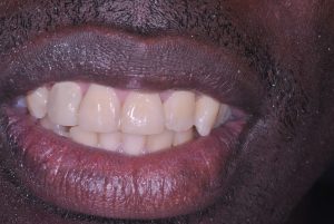 composiet veneers